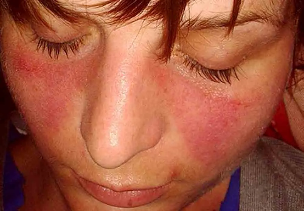 lupus-symptoms-10-warning-signs-and-symptoms-of-lupus-page-2-of-10