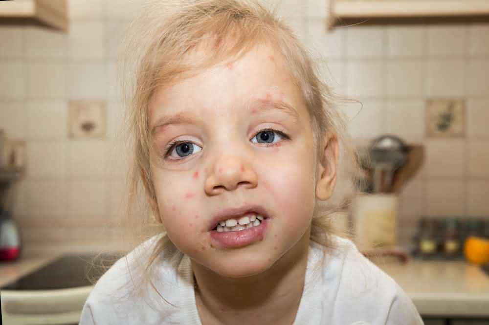 Chickenpox Symptoms; 18 Signs of Chickenpox Page 16 of