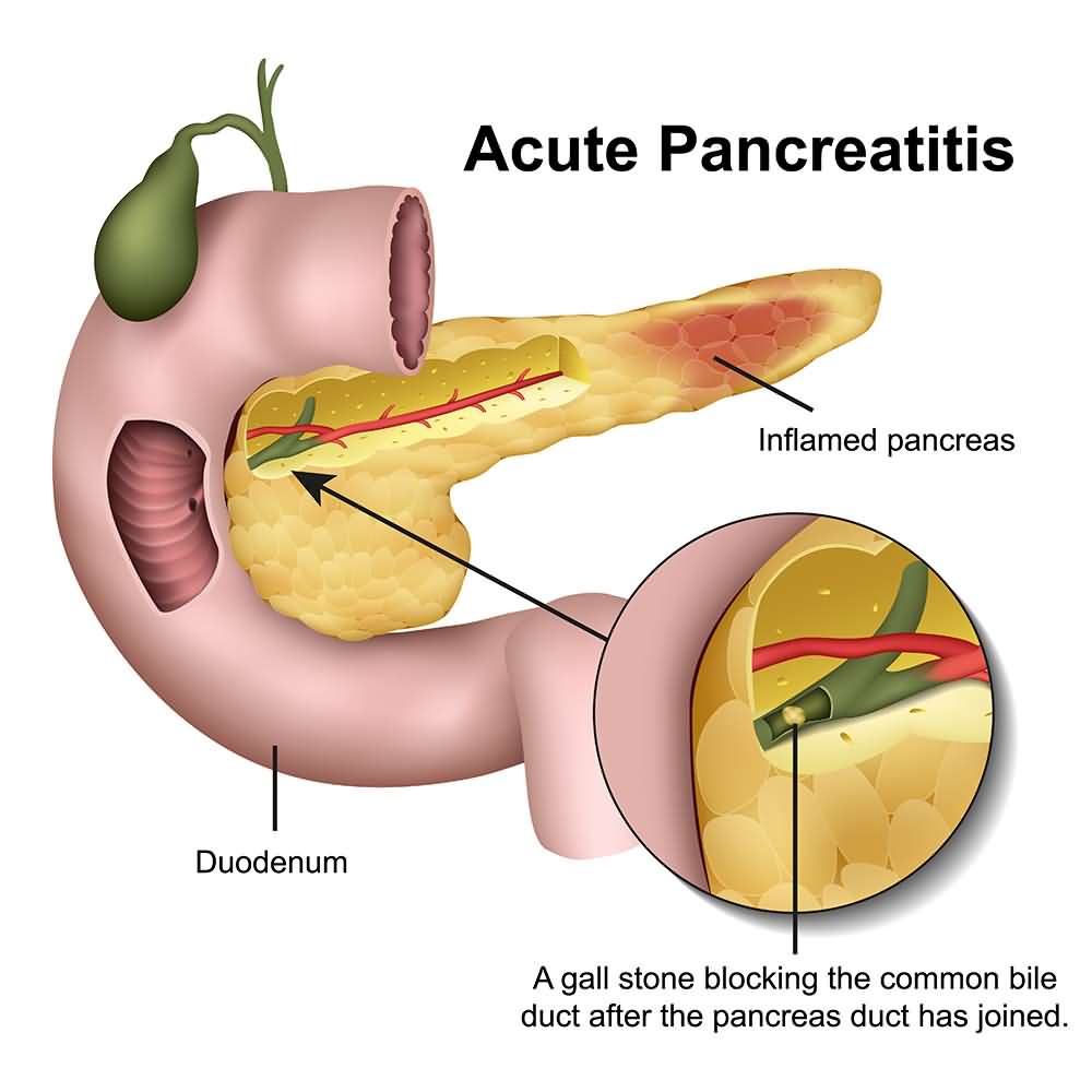 Pancreatitis, Gastrointestinal problems, Mumps symptoms