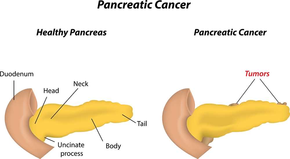 Pancreatic Cancer 10 Silent Signs And Symptoms Healthella 0436