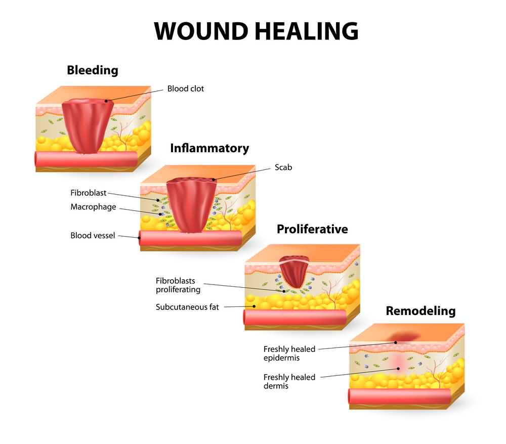 Phases of the wound healing process. Hemostasis, Inflammatory, Proliferative, Maturation and remodeling phase