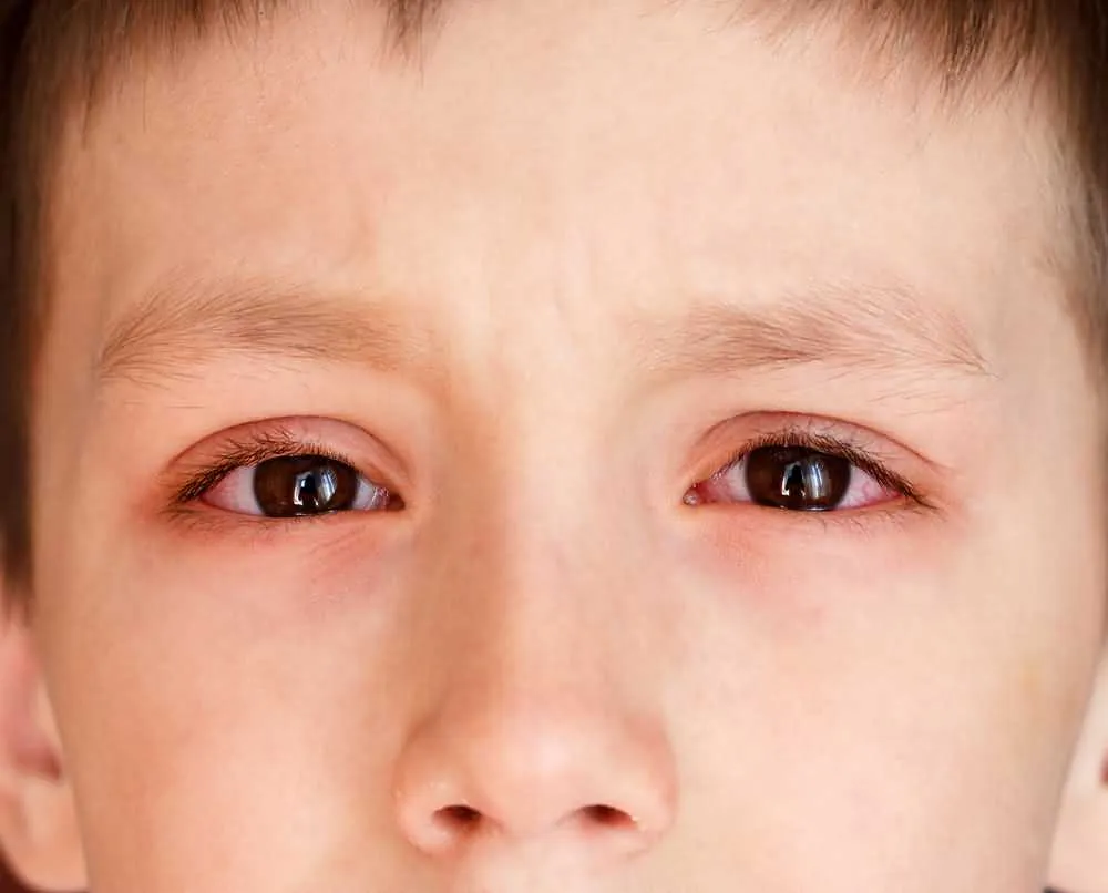 Conjunctivitis, The Andes virus variant of hantavirus infections may also cause conjunctivitis