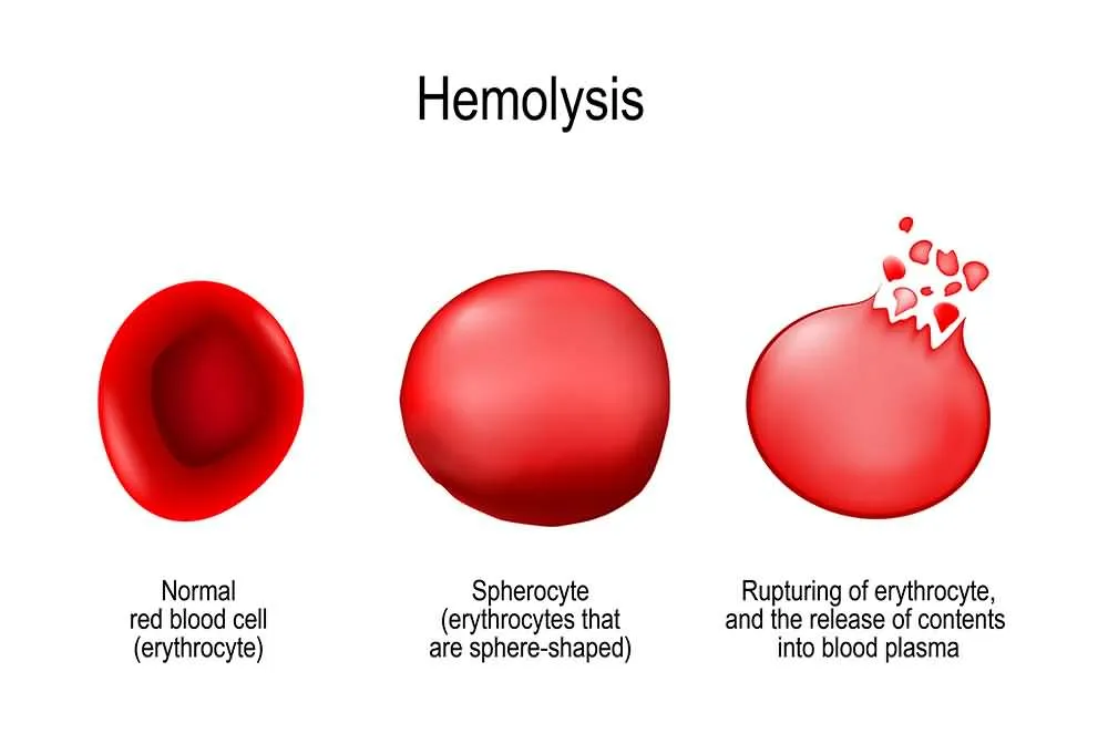 What Does Hemolyzed Blood Mean In Urine