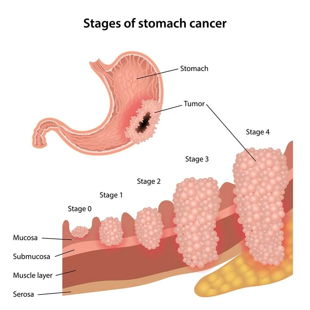 11 Stomach Cancer Symptoms (Gastric Cancer Symptoms) - Page 12