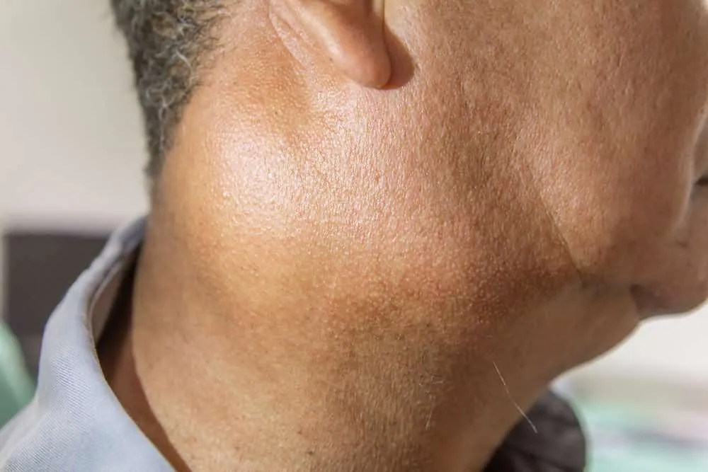 swollen lymph nodes in neck one side