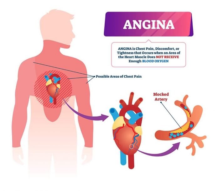 6 Warning Signs Symptoms Of Angina Angina In Females Healthella 6 Warning Signs Symptoms Of Angina Angina In Females Healthella