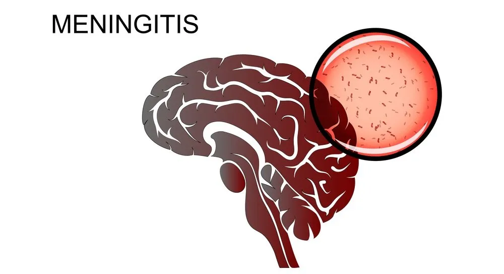 Viral Meningitis; Symptoms, Causes, Diagnosis, And Treatment - Page 5 ...