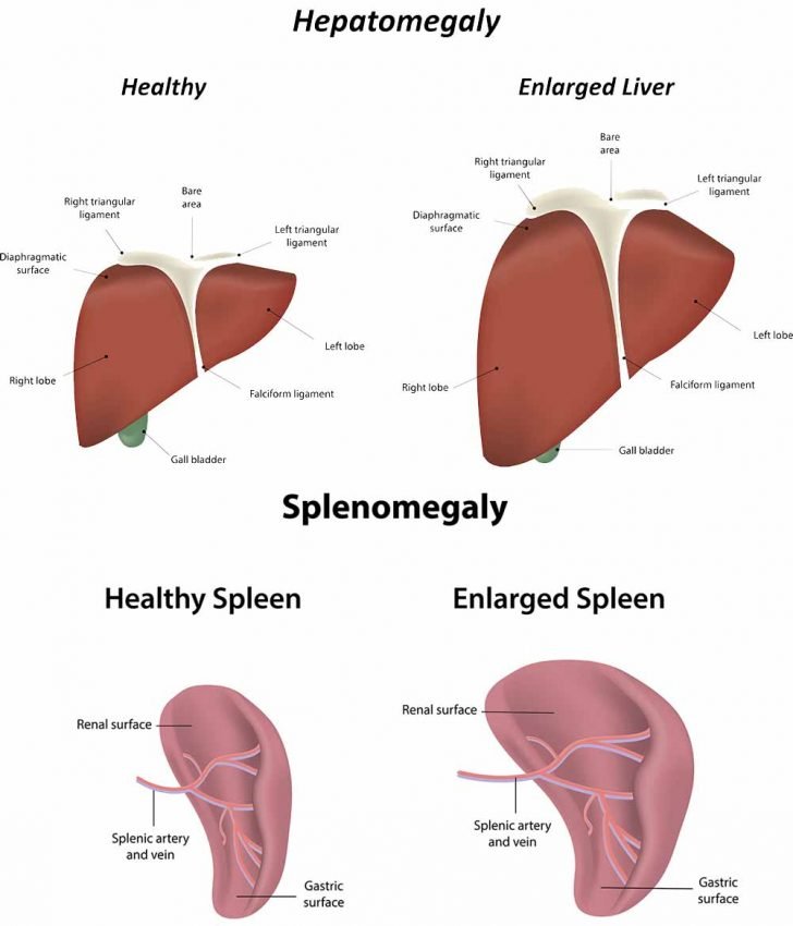 Multiple Myeloma; 14 Multiple Myeloma Symptoms & Multiple Myeloma