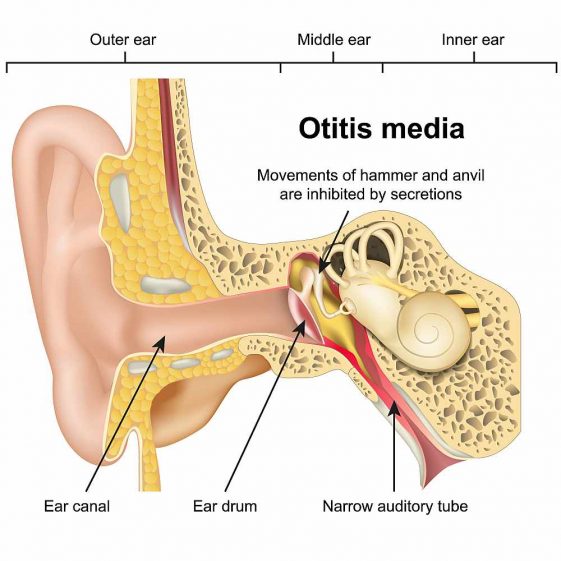 Middle Ear Infection (Otitis Media) Causes, Symptoms, Complications